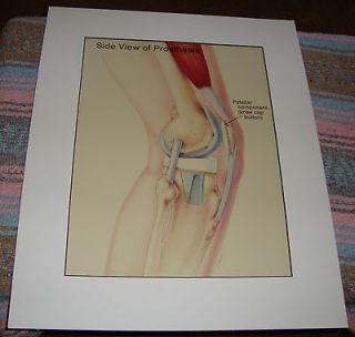 Medical Art Prosthetic Knee Joint Print or Litho