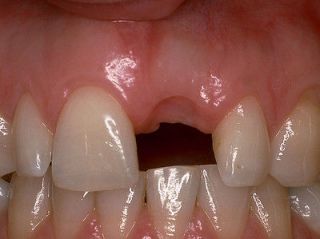 Temporary tooth repair material, moldable plastic