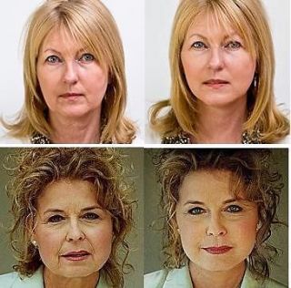 INSTANT FACELIFT & NECKLIFT TAPES KIT   NOW FROM UK